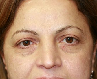 eye-lift-san-diego-59 - before - front