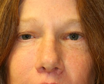eye-lift-san-diego-60 - after - front