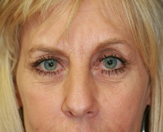 eye-lift-san-diego-61 - before - front