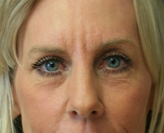 eye-lift-san-diego-61 - after - front