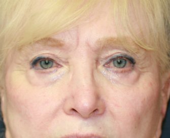 eye-lift-san-diego-62 - before - front