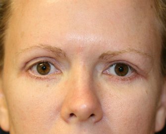 Eyelid-Lift-San-Diego-63 - after - front