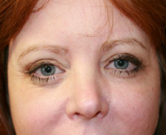 Eyelid-Lift-San-Diego-64 - before - front