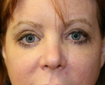 Eyelid-Lift-San-Diego-64 - after - front