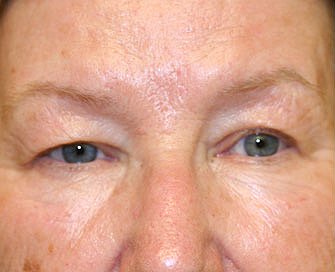 Blepharoplasty Case 6 - before - front