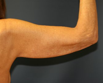 Arm-Lift-San-Diego-7 - before - back