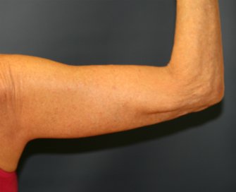 Arm-Lift-San-Diego-7 - after - back