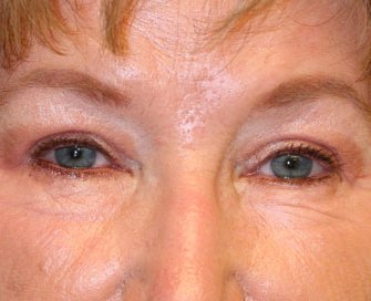 Blepharoplasty Case 6 - after - front