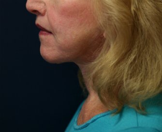 Neck Lift San Diego 21 - after - front