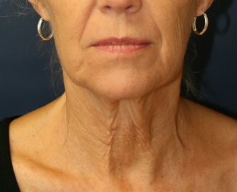 NeckLift San Diego 22 - before - side