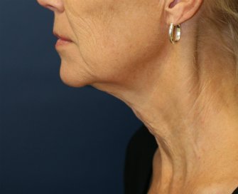 NeckLift San Diego 22 - before - front