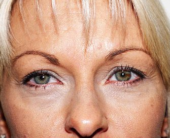 Blepharoplasty Case 7 - before - front