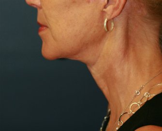NeckLift San Diego 22 - after - front