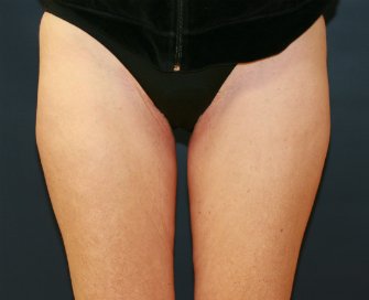Liposuction Outer Thighs - before - front