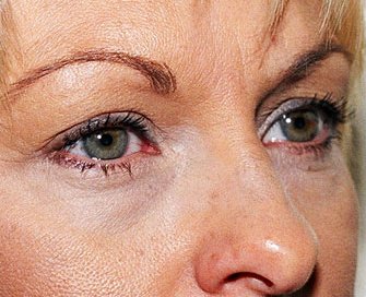 Blepharoplasty Case 7 - before - angle