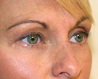 Blepharoplasty Case 7 - after - angle