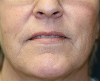 Corner of Lip Lift 24 - before - front