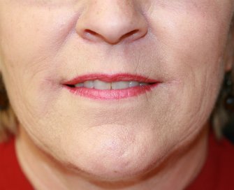 Corner of Lip Lift 24 - after - front