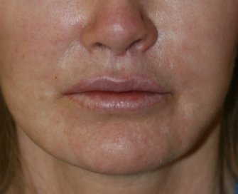 Lip Lift San Diego - after - front