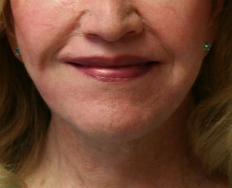 Lip Lift San Diego 26 - before - side