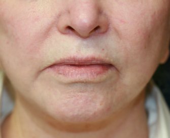 Lip Lift-San-Diego-27 - before - front