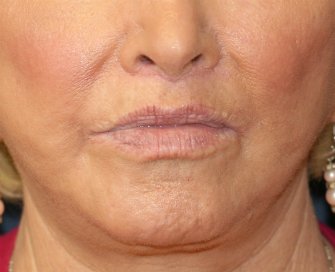 Lip Lift-San-Diego-27 - after - front