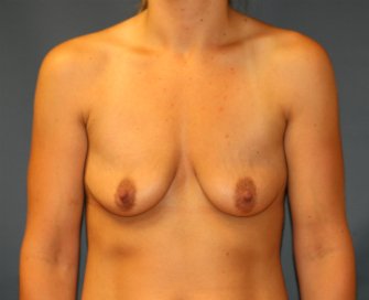 Breast Enhancement San Diego 85 - before - front