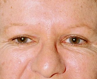 Blepharoplasty Case 9 - after - front