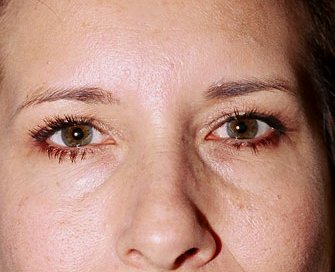 Blepharoplasty Case 10 - before - front