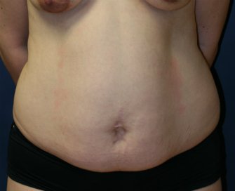 Tummy Tuck San Diego 51 - before - front