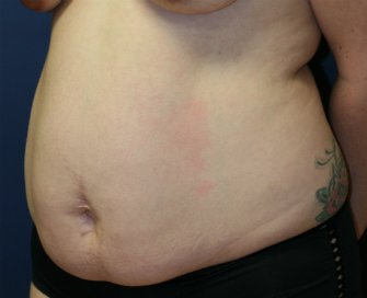 Tummy Tuck San Diego 51 - before - oblique