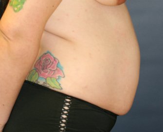 Tummy Tuck San Diego 51 - before - side