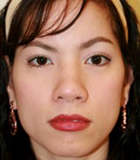 Rhinoplasty Case 3 - before - front