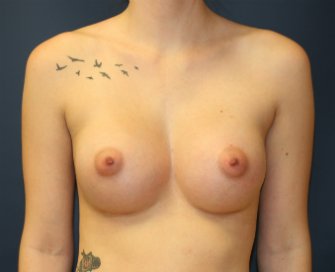 Breast Augmentation San Diego 88 - after - front