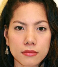 Rhinoplasty Case 3 - after - front