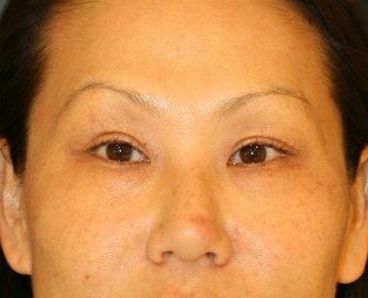 eyelid-surgery-san-diego-66 - after - front