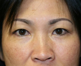 eyelid-surgery-san-diego-67 - before - front