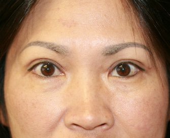 eyelid-surgery-san-diego-67 - after - front