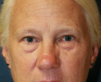 eyelid-surgery-san-diego-68 - before - front