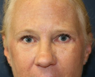 eyelid-surgery-san-diego-68 - after - front