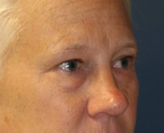 eyelid-surgery-san-diego-68 - before - oblique