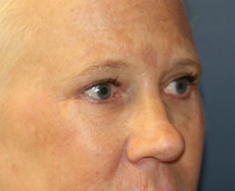 eyelid-surgery-san-diego-68 - after - oblique