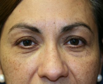 eyelid-surgery-san-diego-69 - before - front