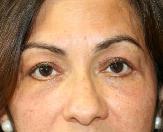 eyelid-surgery-san-diego-69 - after - front