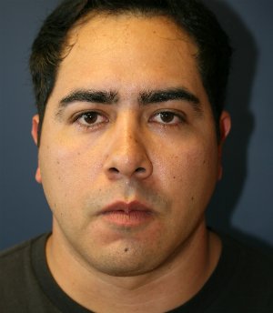 Neck Lift San Diego 23 - after - side