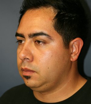 Neck Lift San Diego 23 - before - oblique
