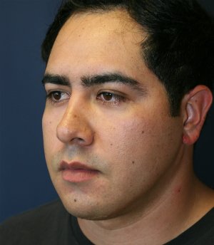 Neck Lift San Diego 23 - after - oblique