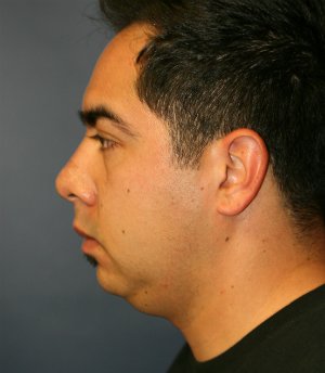 Neck Lift San Diego 23 - before - front