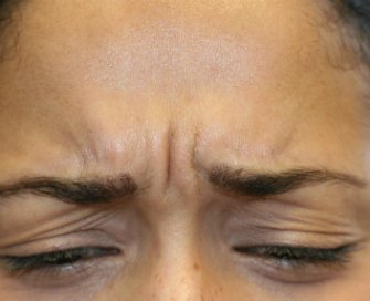 Botox between brows - before - front