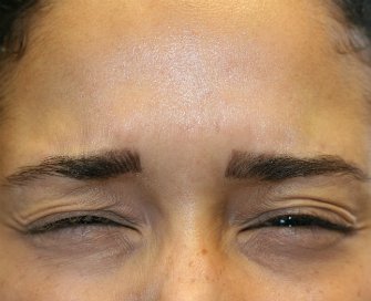 Botox between brows - after - front